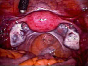 Вагітність після лапароскопії