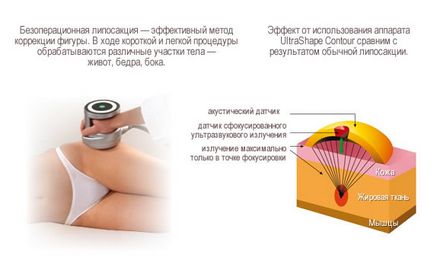 Liposucția non-chirurgicală în clinica de lantan, prețurile - moscow