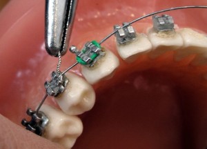 Чи боляче ставити брекети на зуби особливості процедури