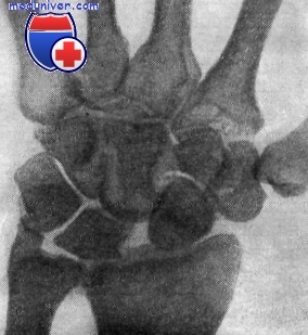 Біль в руці через асептичного некрозу човноподібної кістки і деформуючому остеоартрозі