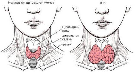 Care este diferența dintre hipotiroidism și hipertiroidism și poate trece la altul