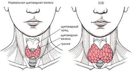 Mi a különbség hypothyreosis pajzsmirigy-túlműködés, és azt, hogy egy lépés a másikra