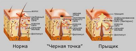 Чорні точки на обличчі причини, як позбутися в домашніх умовах