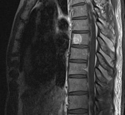Mi a hemangioma a gerinc tünetei és kezelése népi jogorvoslati Ellenjavallatok (népi) Mi a hemangioma a gerinc tünetei és kezelése népi jogorvoslati Ellenjavallatok