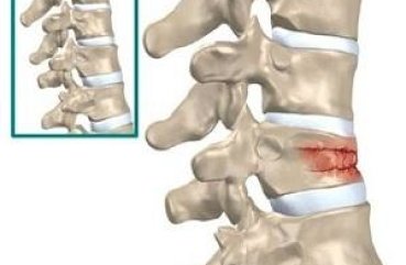 Mi a hemangioma a gerinc tünetei és kezelése népi jogorvoslati Ellenjavallatok (népi) Mi a hemangioma a gerinc tünetei és kezelése népi jogorvoslati Ellenjavallatok