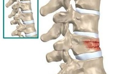 Mi a hemangioma a gerinc tünetei és kezelése népi jogorvoslati Ellenjavallatok