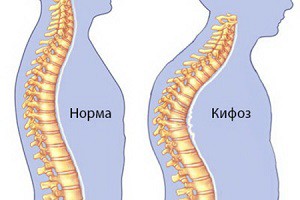 Ce este cifoza netezită a coloanei vertebrale