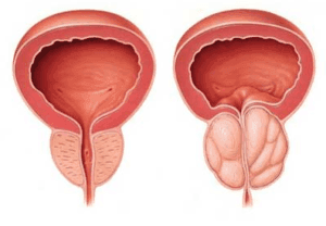Qigong pentru tratamentul prostatitei și a adenomului de prostată