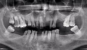 Diagnosticul de înfrângere a furcației dinților multi-înrădăcinate