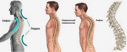 Diagnosticul - cifoza toracică este netezită - ce înseamnă acest lucru, cum să tratăm