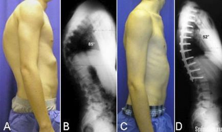 Diagnosticul - cifoza toracică este netezită - ce înseamnă acest lucru, cum să tratăm