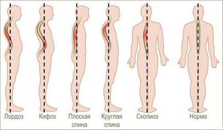 Diagnosticul - cifoza toracică este netezită - ce înseamnă acest lucru, cum să tratăm