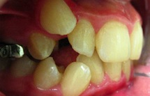 Mucoasa distala - cresterea maxilarului superior sau inferior la adulti si copii - dentara