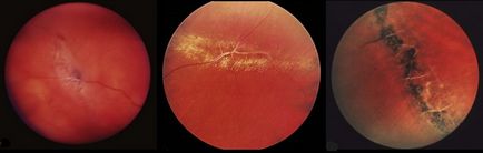 Distrofie după tipul de cohlee - pe retina ochiului - cauze, simptome și tratament