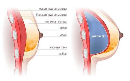 Endoproteticele glandelor mamare la Moscova, prețurile pentru endoproteticele glandelor