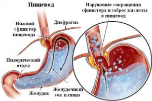 Esofagită - simptome ale unor forme majore ale bolii