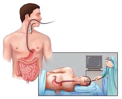 Scopul și descrierea esofagogastroduodenoscopiei