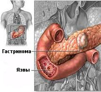 Gastrinomul - cauze, simptome, diagnostic și tratament