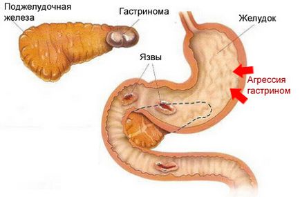 Gastrinom simptome, diagnostic, tratament și complicații