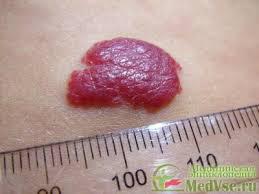 Hemangioma tünetek, kezelés, leírás