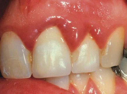 Tratamentul gingivitelor, cauze, simptome, preturi la Moscova, prevenirea gingivitei virale