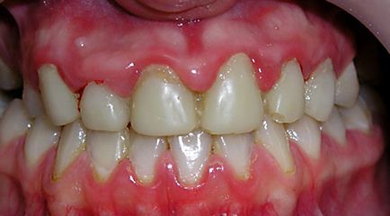 Tratamentul gingivitelor, cauze, simptome, preturi la Moscova, prevenirea gingivitei virale