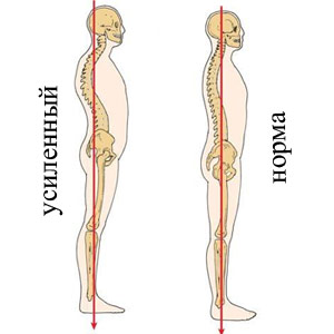 Mellkasi kyphosis fokozott vagy simított - mi ez, tünetei és okai betegségek a gerinc