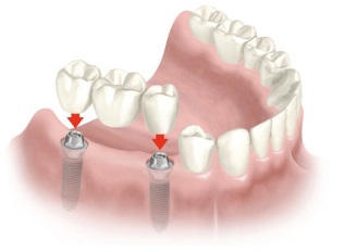 Implantátum Art Ufa - fogászati ​​implantátumok és fogorvosi kezelés, modern fogászati ​​implantátumok