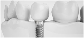 Implantátum Art Ufa - fogászati ​​implantátumok és fogorvosi kezelés, modern fogászati ​​implantátumok