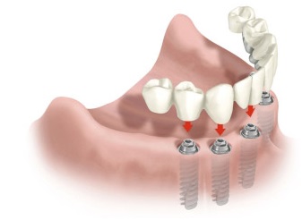 Імплант арт Херсон - зубні імплантати і лікування зубів, сучасні зубні імплантати