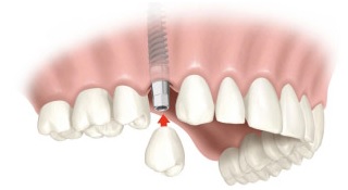 Implantátum Art Ufa - fogászati ​​implantátumok és fogorvosi kezelés, modern fogászati ​​implantátumok