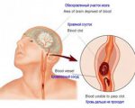 Accident vascular cerebral - tratamentul bolii