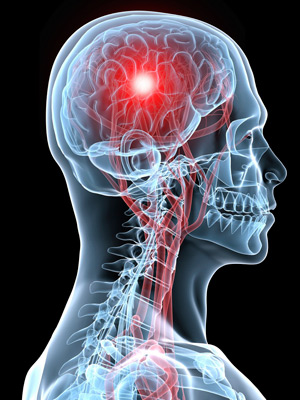 Accident vascular cerebral - tratamentul bolii