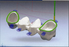 Efectuarea de coroane artificiale cu sisteme cad cam în stomatologie avantis