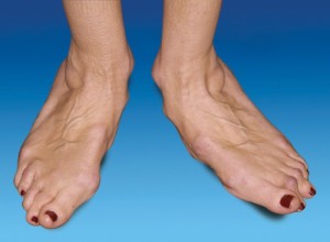 Cum se manifestă artrita reumatoidă a piciorului?