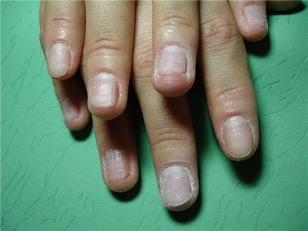Як відновити нігті після нарощування і вилікувати їх - манікюр в домашніх умовах