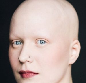 Як відновити волосся після хіміотерапії
