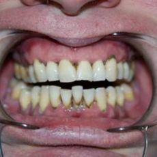 Cum să închizi coarda între dinți