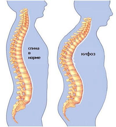 Cifoza coloanei vertebrale toracice provoacă curbură, grad