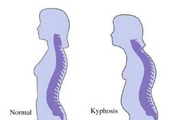 Cifoza coloanei vertebrale toracice provoacă curbură, grad