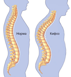 Кіфоз грудного відділу хребта симптоми і лікування