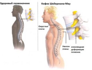 Cifoza coloanei vertebrale toracice și simptome