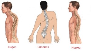 Cifoza coloanei vertebrale toracice și simptome