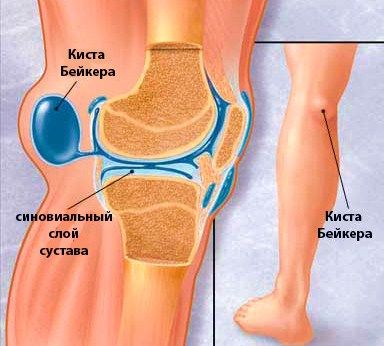 Кіста Бейкера колінного суглоба, причини, симптоми, лікування