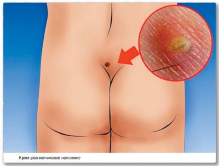 Cistul coccygeal se referă la toate cauzele, simptomele, tratamentul; fotografie