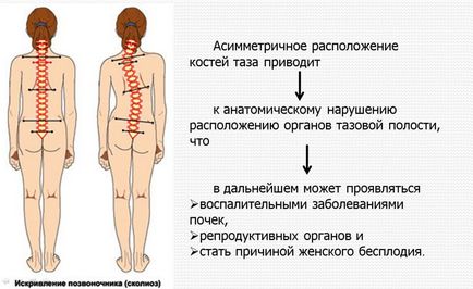 Комплекс вправ при сколіозі як прибрати викривлення хребта