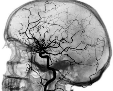 Diagnosticarea CT a creierului este ceea ce este, anatomia; emisie