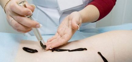 Proprietățile leechului terapeutic, aplicație în medicină