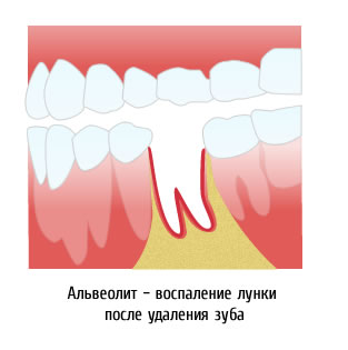 Tratamentul alveolitei, pericoronită - costul tratamentului