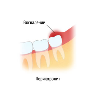 Tratamentul alveolitei, pericoronită - costul tratamentului